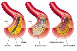 Come funziona l’angioplastica